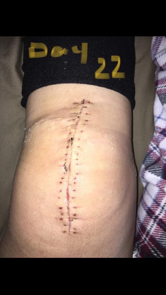 Knee Replacement Scar Recovery Timeline A Photo Gallery